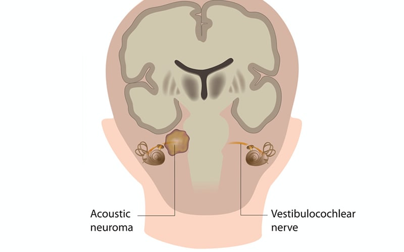 Acoustic Neuroma Expalined