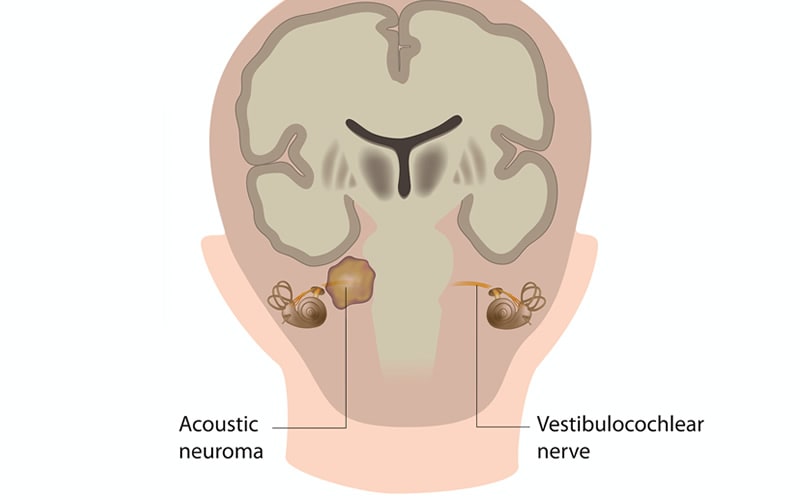 auditory nerve neuroma