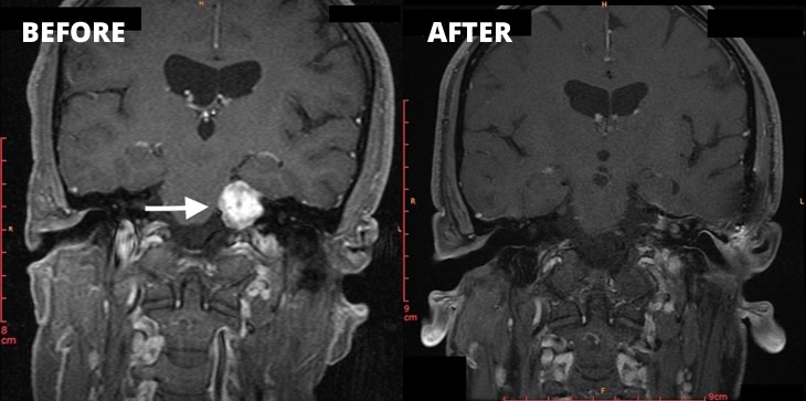 Case study Acoustic Neuroma