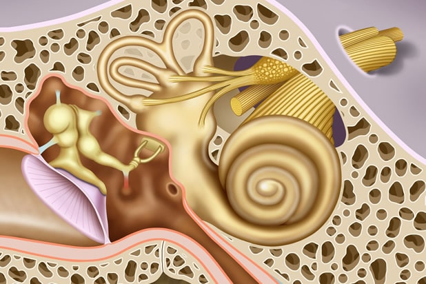 auditory nerve neuroma