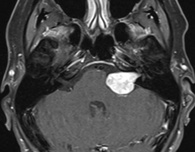 MRI Images of Large Acoustic Neuroma