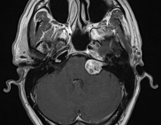 Acoustic Neuroma MRI