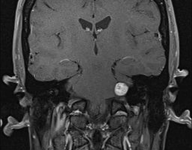 MRI Images of medium Acoustic Neuroma
